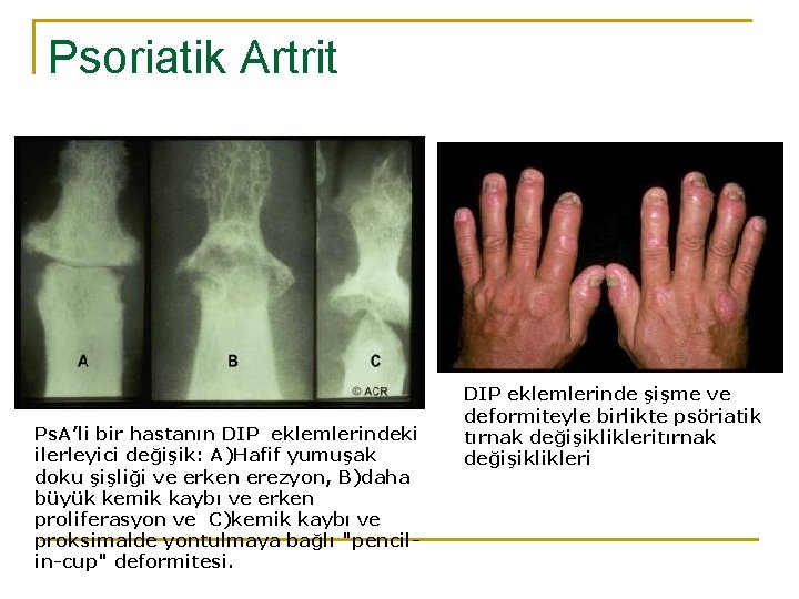 Psoriatik Artrit Ps. A’li bir hastanın DIP eklemlerindeki ilerleyici değişik: A)Hafif yumuşak doku şişliği