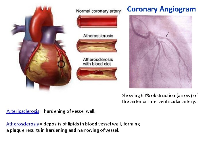 Coronary Angiogram Showing 60% obstruction (arrow) of the anterior interventricular artery. Arteriosclerosis = hardening