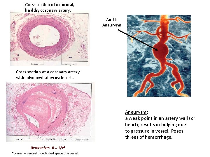 Cross section of a normal, healthy coronary artery. Aortic Aneurysm Cross section of a
