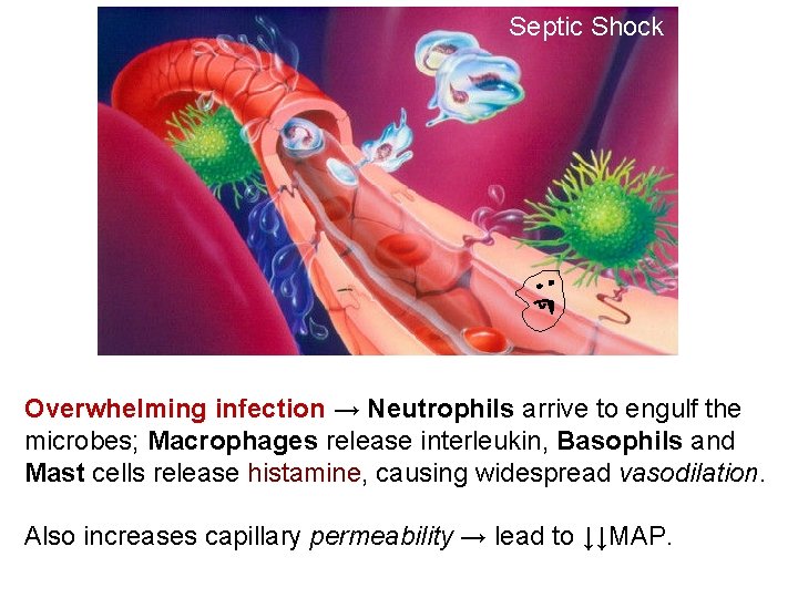 Septic Shock Overwhelming infection → Neutrophils arrive to engulf the microbes; Macrophages release interleukin,