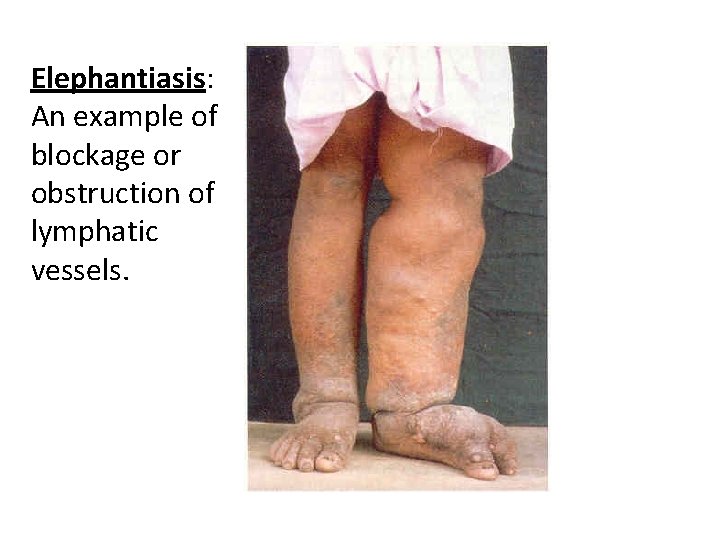 Elephantiasis: An example of blockage or obstruction of lymphatic vessels. 