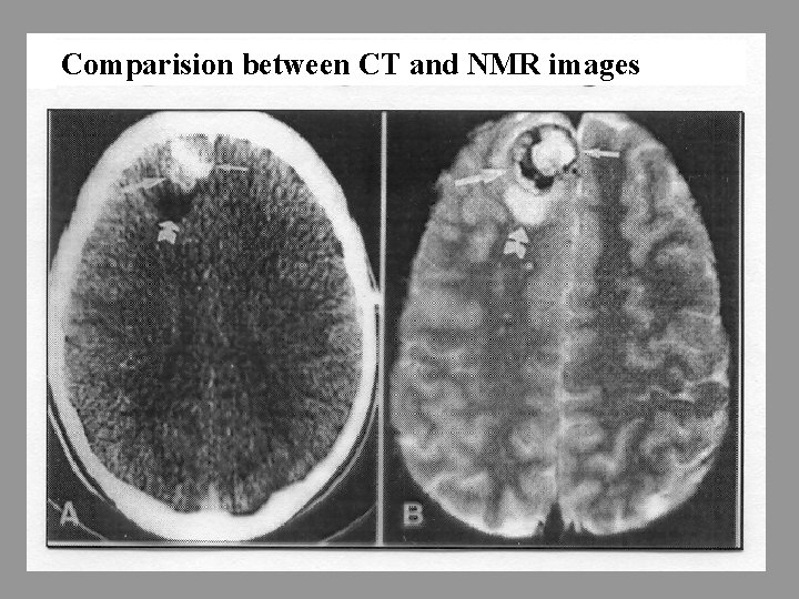 Comparision between CT and NMR images 