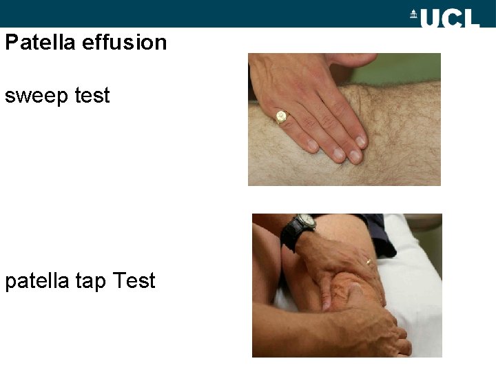 Patella effusion sweep test patella tap Test 