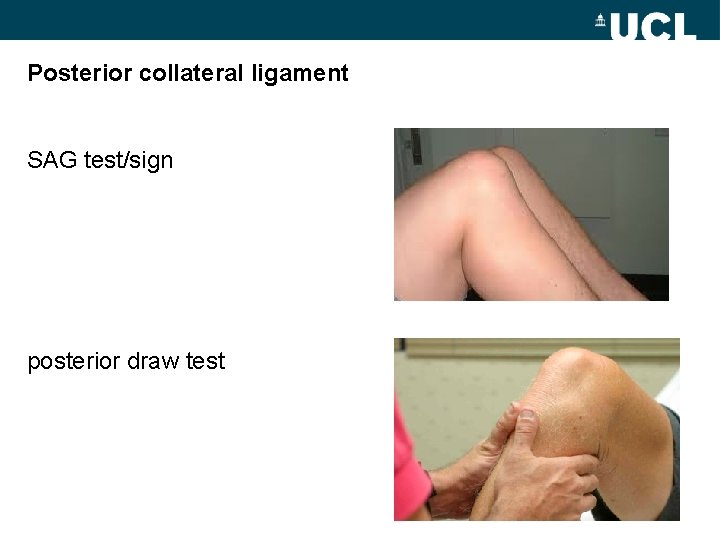 Posterior collateral ligament SAG test/sign posterior draw test 