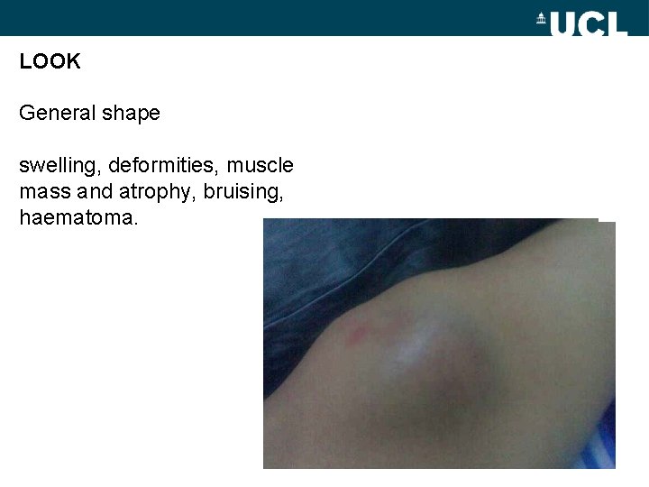 LOOK General shape swelling, deformities, muscle mass and atrophy, bruising, haematoma. 