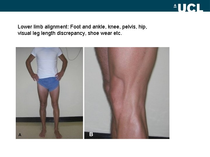 Lower limb alignment: Foot and ankle, knee, pelvis, hip, visual leg length discrepancy, shoe