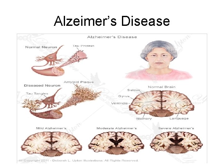 Alzeimer’s Disease 