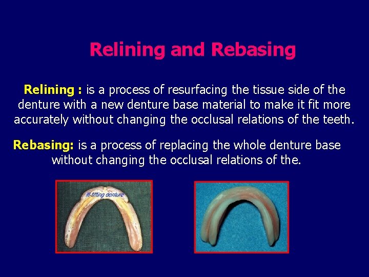 Relining and Rebasing Relining : is a process of resurfacing the tissue side of