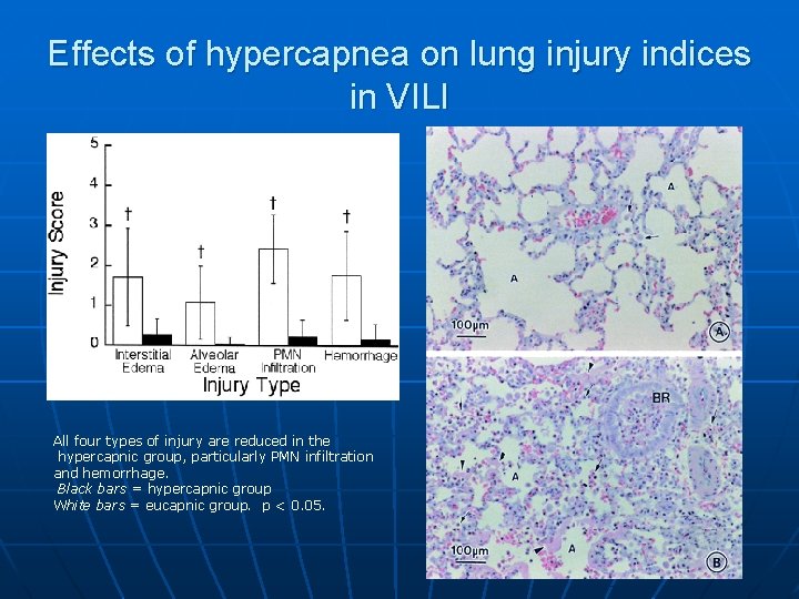 Effects of hypercapnea on lung injury indices in VILI All four types of injury