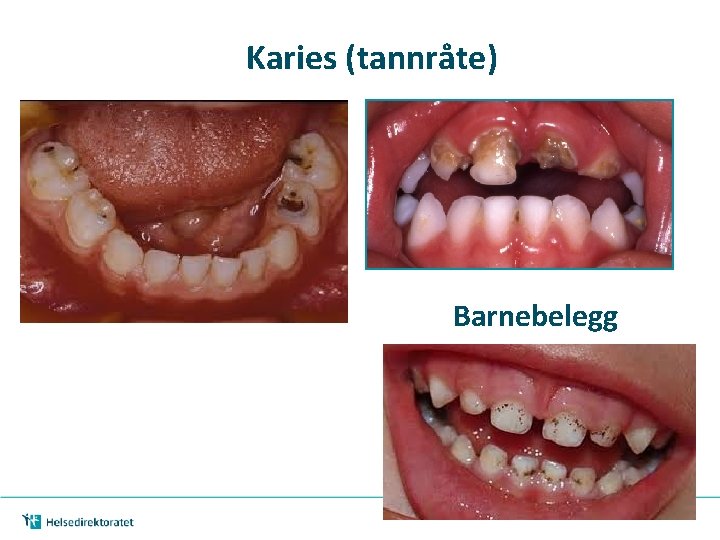 Karies (tannråte) Barnebelegg 