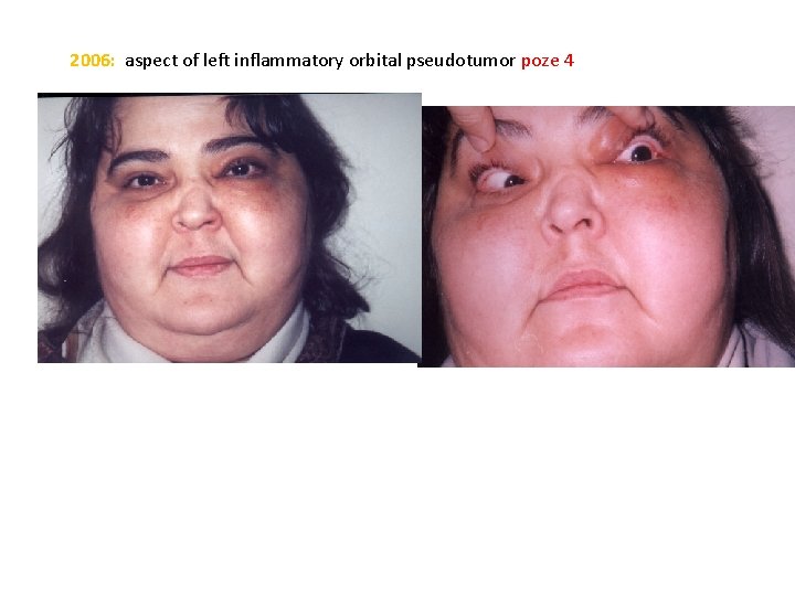 2006: aspect of left inflammatory orbital pseudotumor poze 4 