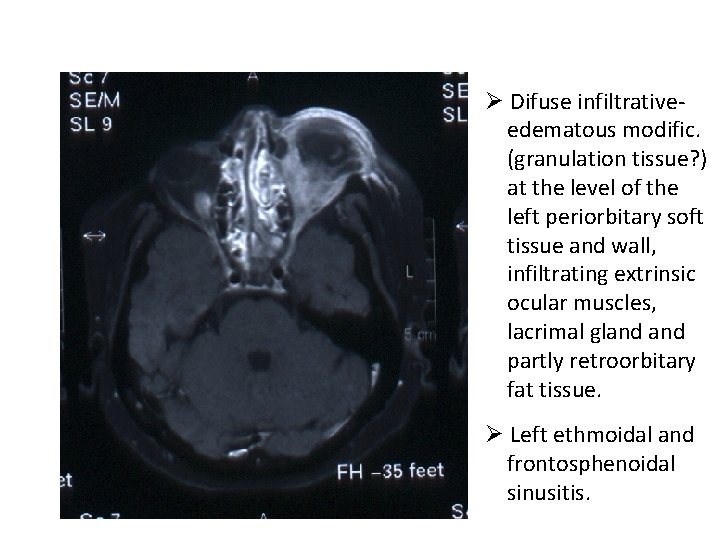 Ø Difuse infiltrativeedematous modific. (granulation tissue? ) at the level of the left periorbitary