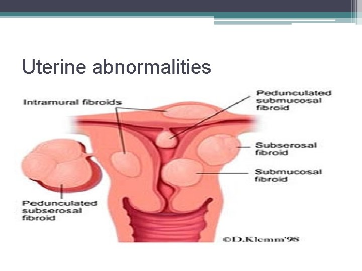Uterine abnormalities 