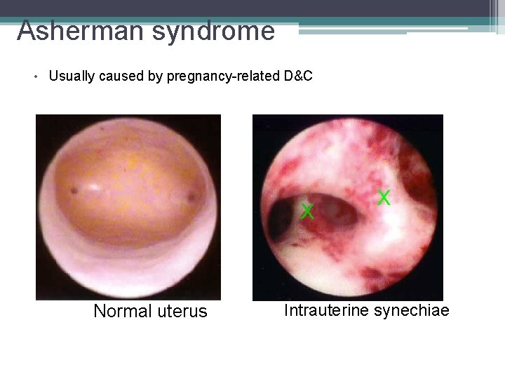 Asherman syndrome • Usually caused by pregnancy-related D&C Normal uterus Intrauterine synechiae 