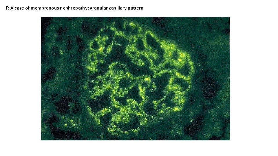 IF: A case of membranous nephropathy: granular capillary pattern 