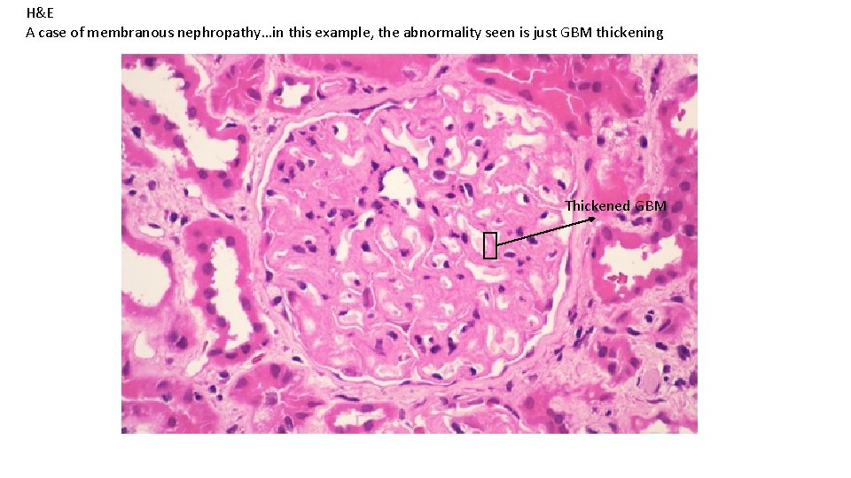 H&E A case of membranous nephropathy…in this example, the abnormality seen is just GBM