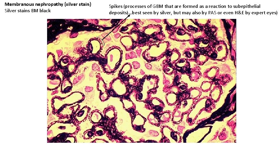Membranous nephropathy (silver stain) Silver stains BM black Spikes (processes of GBM that are
