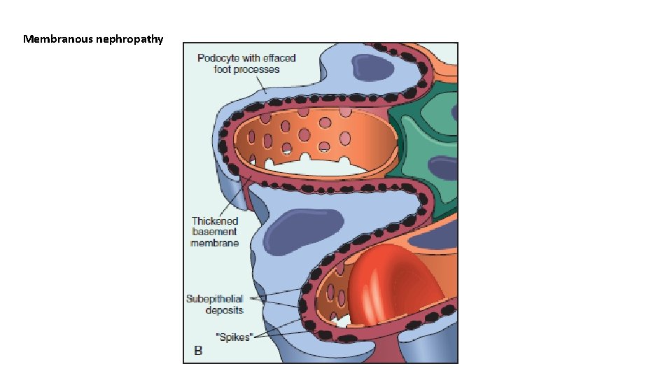Membranous nephropathy 