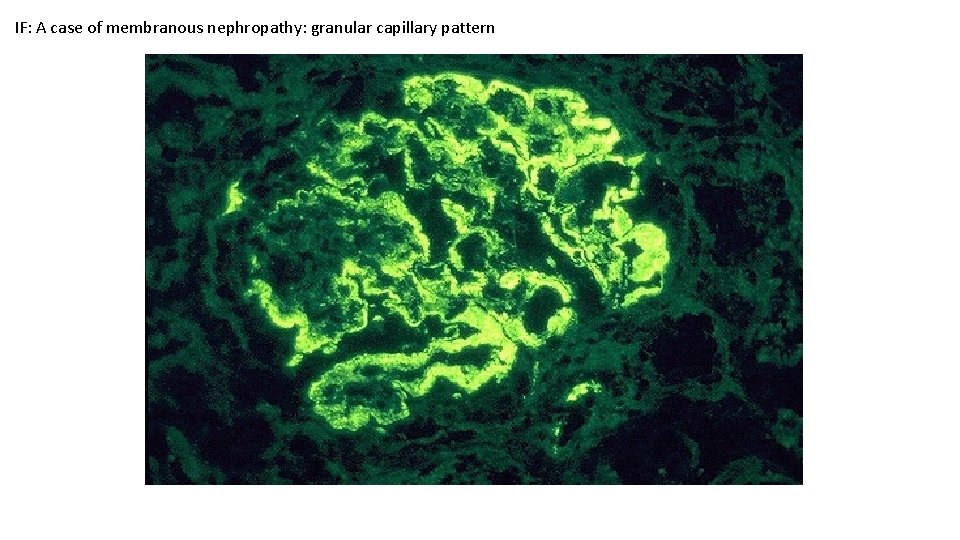 IF: A case of membranous nephropathy: granular capillary pattern 
