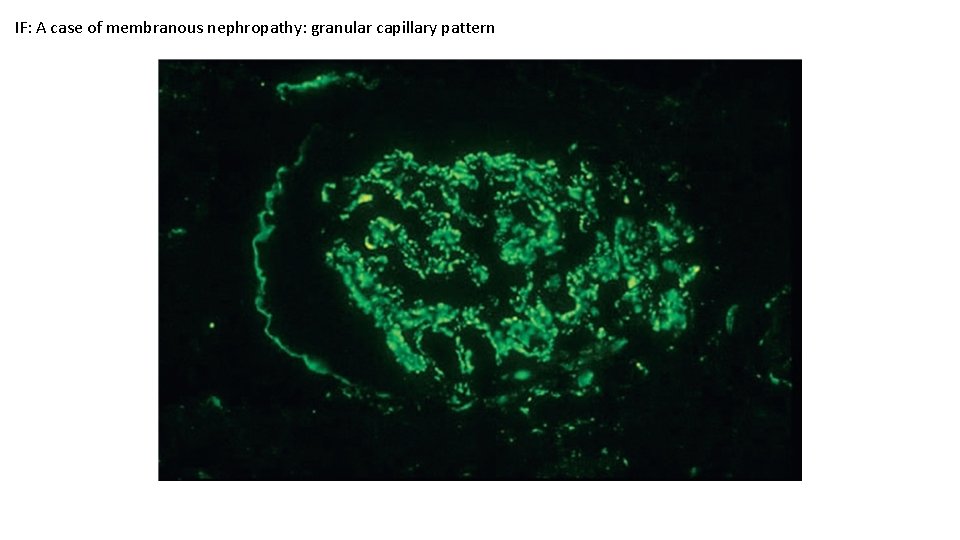 IF: A case of membranous nephropathy: granular capillary pattern 