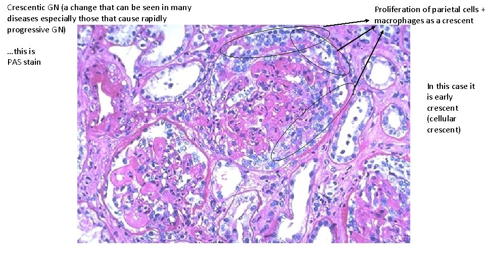 Crescentic GN (a change that can be seen in many diseases especially those that