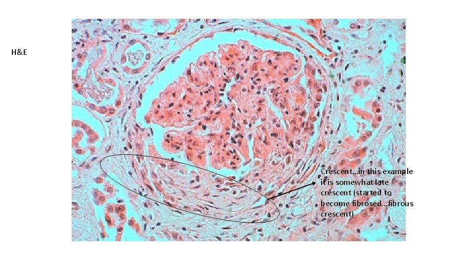 H&E Crescent…in this example it is somewhat late crescent (started to become fibrosed…fibrous crescent)