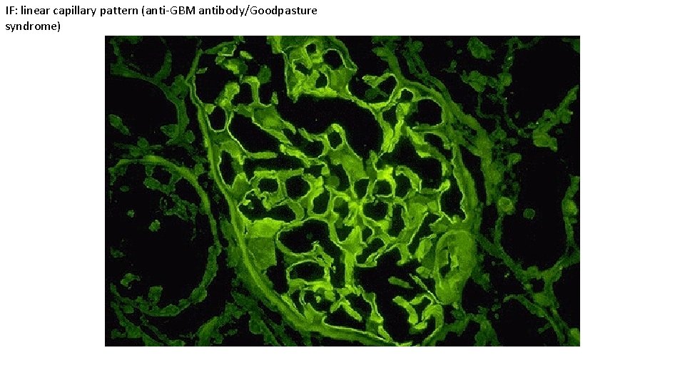 IF: linear capillary pattern (anti-GBM antibody/Goodpasture syndrome) 