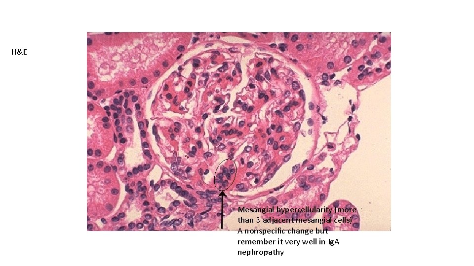 H&E Mesangial hypercellularity (more than 3 adjacent mesangial cells) A nonspecific change but remember