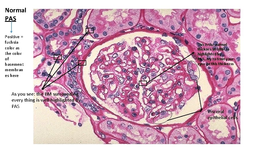 Normal PAS Positive = fuchsia color as the color of basement membran es here