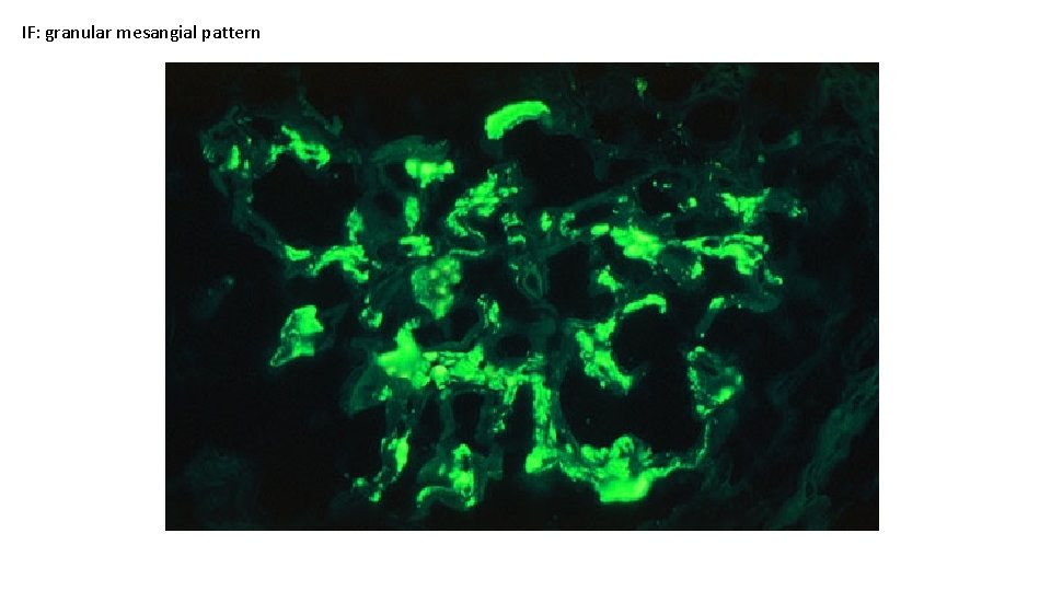 IF: granular mesangial pattern 