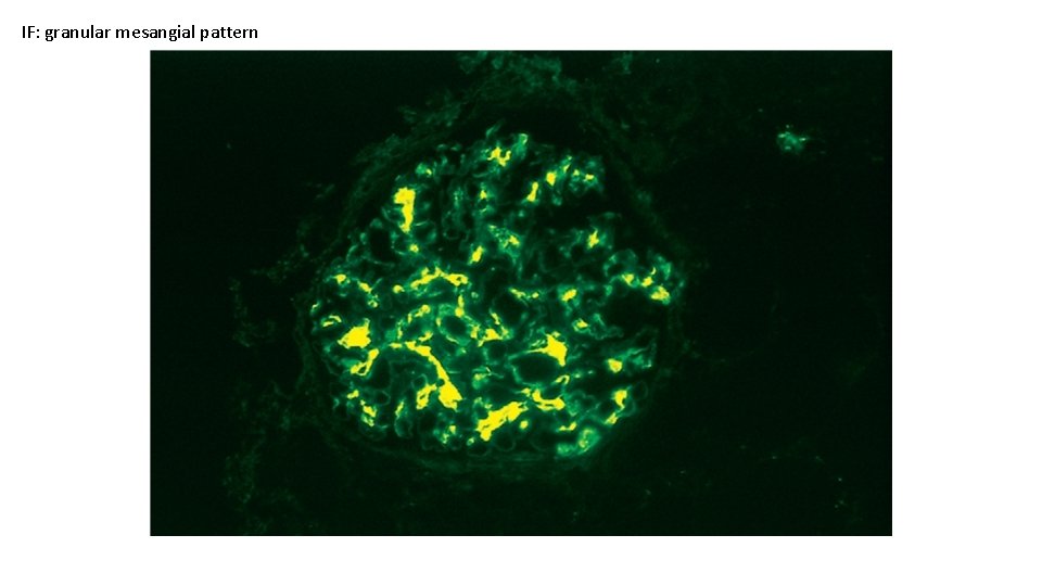 IF: granular mesangial pattern 