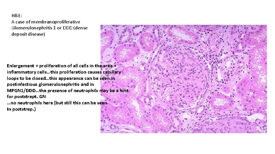H&E: A case of membranoproliferative Glomerulonephritis 1 or DDD (dense deposit disease) Enlargement +