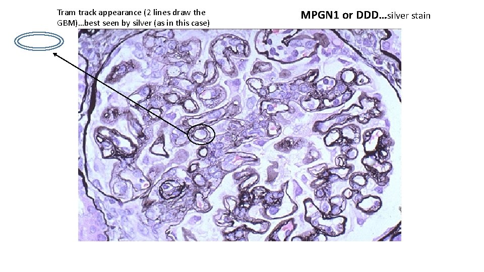 Tram track appearance (2 lines draw the GBM)…best seen by silver (as in this