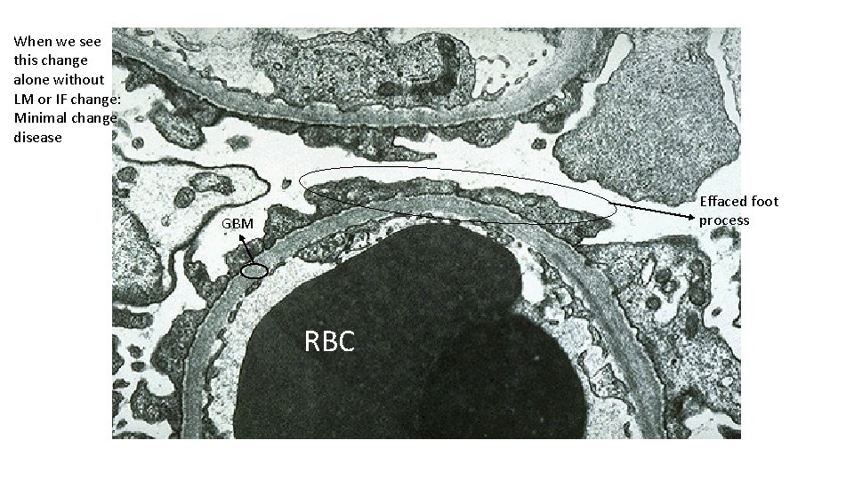 When we see this change alone without LM or IF change: Minimal change disease