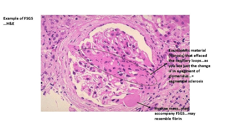 Example of FSGS …H&E Eosinophilic material (fibrosis) that effaced the capillary loops…as you see