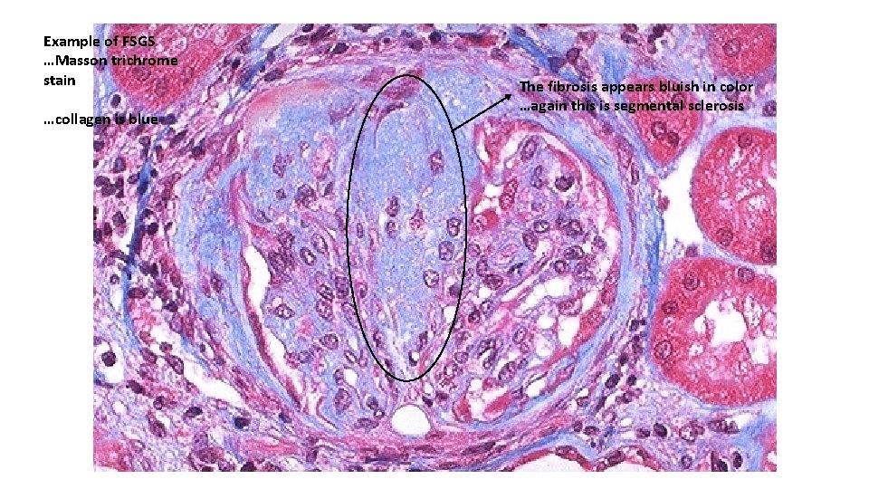 Example of FSGS …Masson trichrome stain …collagen is blue The fibrosis appears bluish in