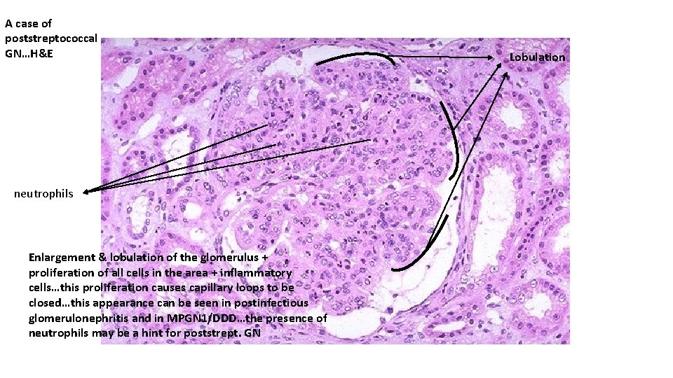 A case of poststreptococcal GN…H&E neutrophils Enlargement & lobulation of the glomerulus + proliferation