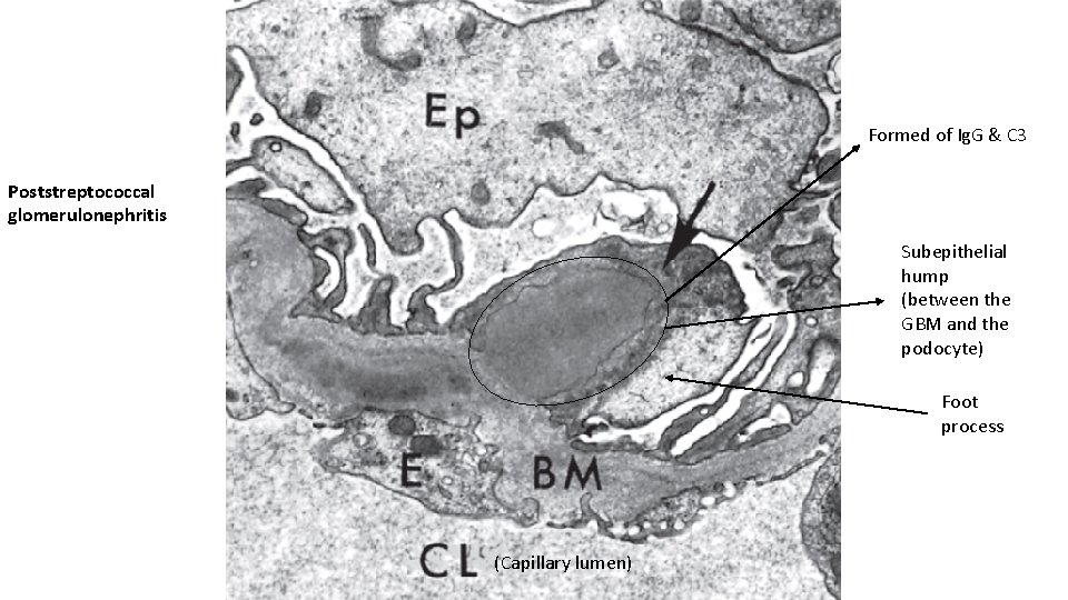 Formed of Ig. G & C 3 Poststreptococcal glomerulonephritis Subepithelial hump (between the GBM