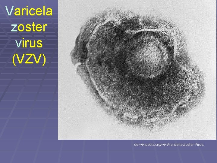 Varicela zoster virus (VZV) de. wikipedia. org/wiki/Varizella-Zoster-Virus. 