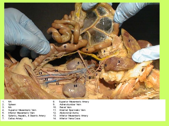 1. 2. 3. 4. 5. 6. 7. NA Spleen NA Superior Mesenteric Vein Inferior