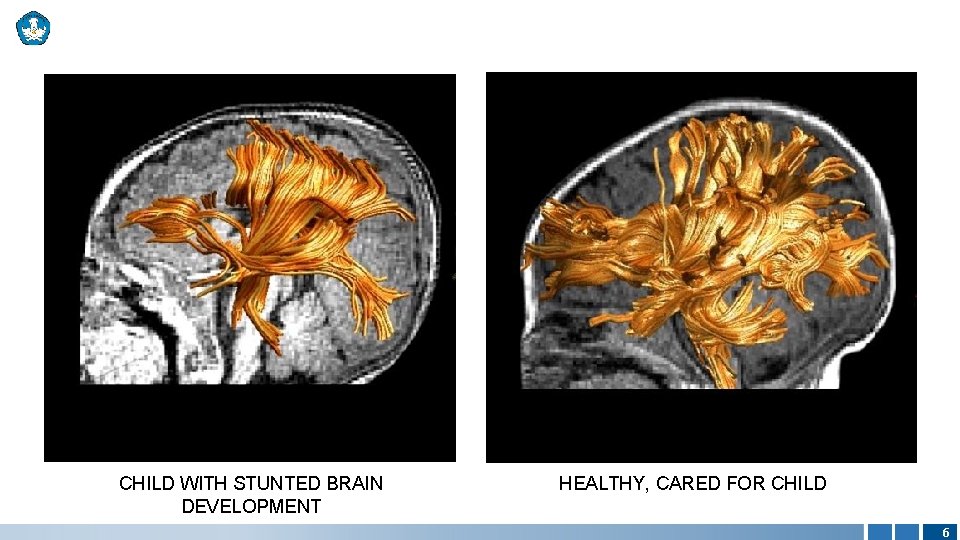 CHILD WITH STUNTED BRAIN DEVELOPMENT HEALTHY, CARED FOR CHILD 6 