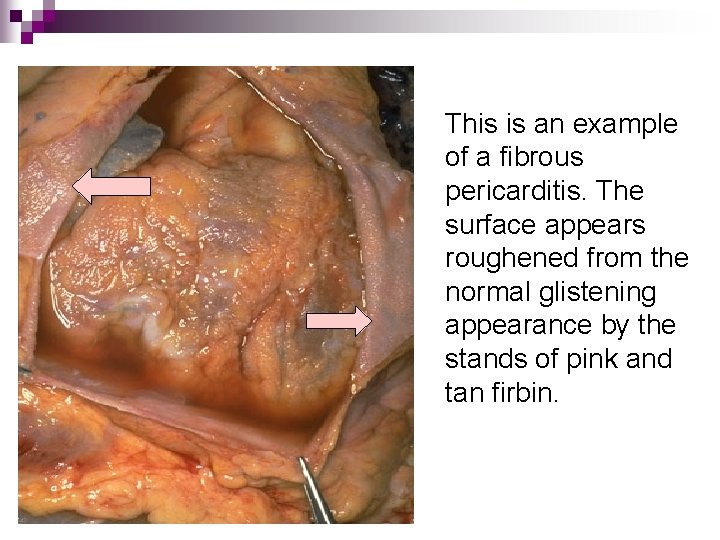 This is an example of a fibrous pericarditis. The surface appears roughened from the