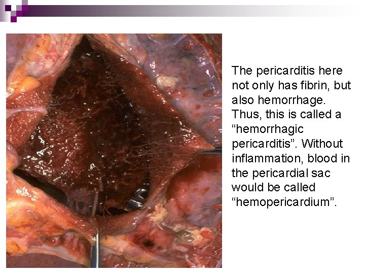 The pericarditis here not only has fibrin, but also hemorrhage. Thus, this is called