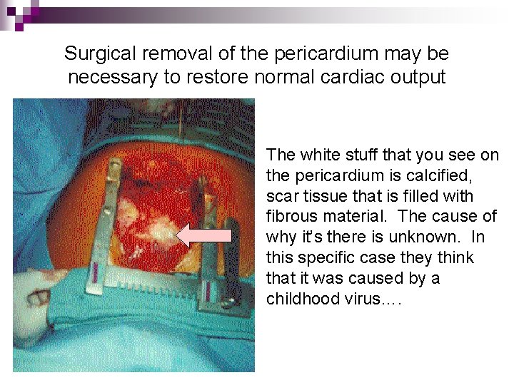 Surgical removal of the pericardium may be necessary to restore normal cardiac output The