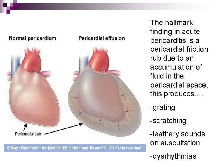 The hallmark finding in acute pericarditis is a pericardial friction rub due to an