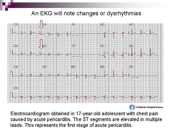 An EKG will note changes or dysrhythmias Electrocardiogram obtained in 17 -year-old adolescent with