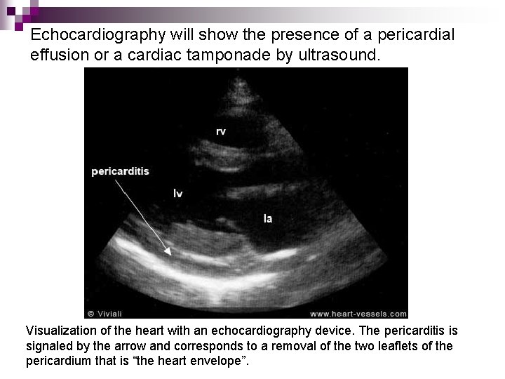 Echocardiography will show the presence of a pericardial effusion or a cardiac tamponade by