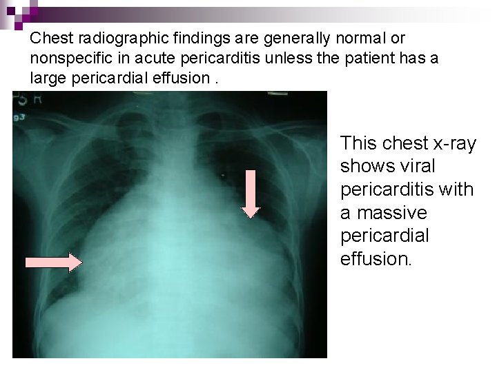 Chest radiographic findings are generally normal or nonspecific in acute pericarditis unless the patient