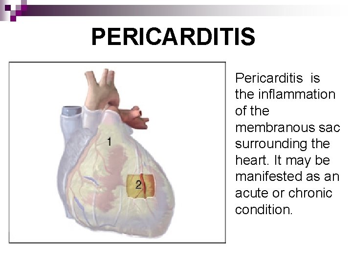 PERICARDITIS Pericarditis is the inflammation of the membranous sac surrounding the heart. It may
