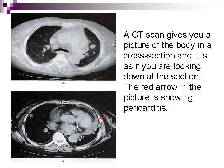 A CT scan gives you a picture of the body in a cross-section and